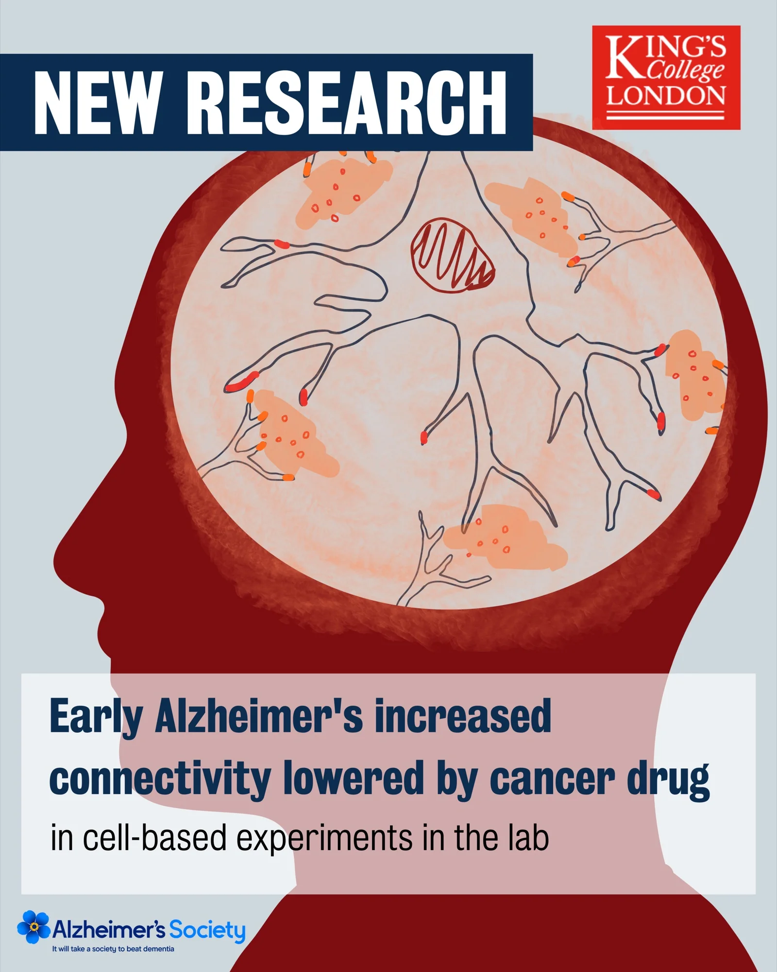 Early Alzheimers increased connectivity lowered by cancer drug in the lab
