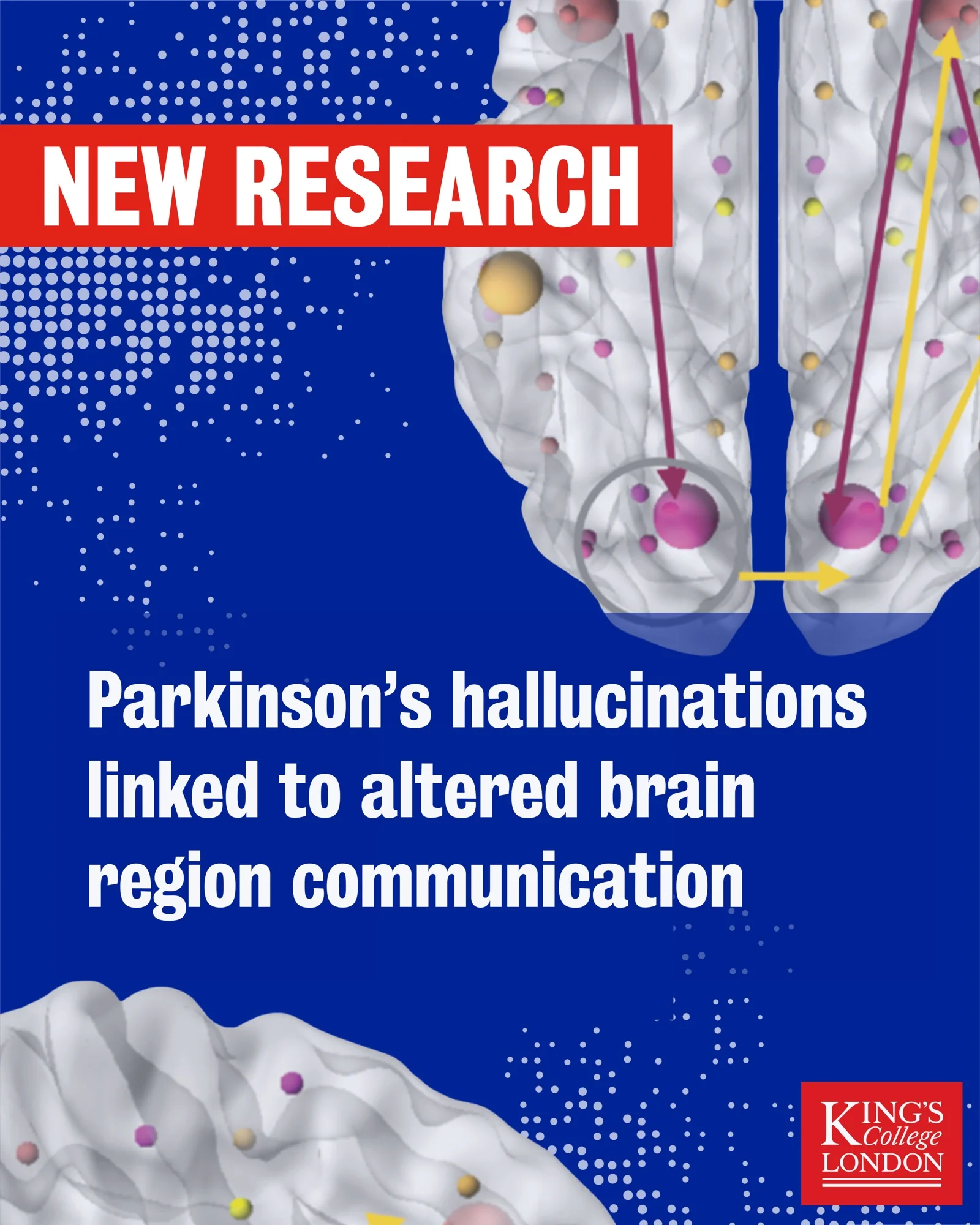 Parkinsons hallucinations linked to altered brain region communications
